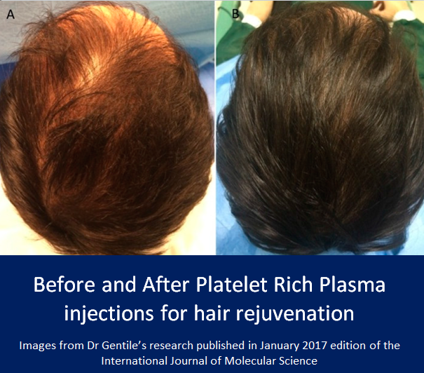 PRP Platelet-Rich Plasma - Hair Restoration - The Esthetic Studio